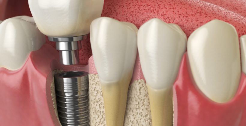 Do Dental Implants Work Like Real Teeth?