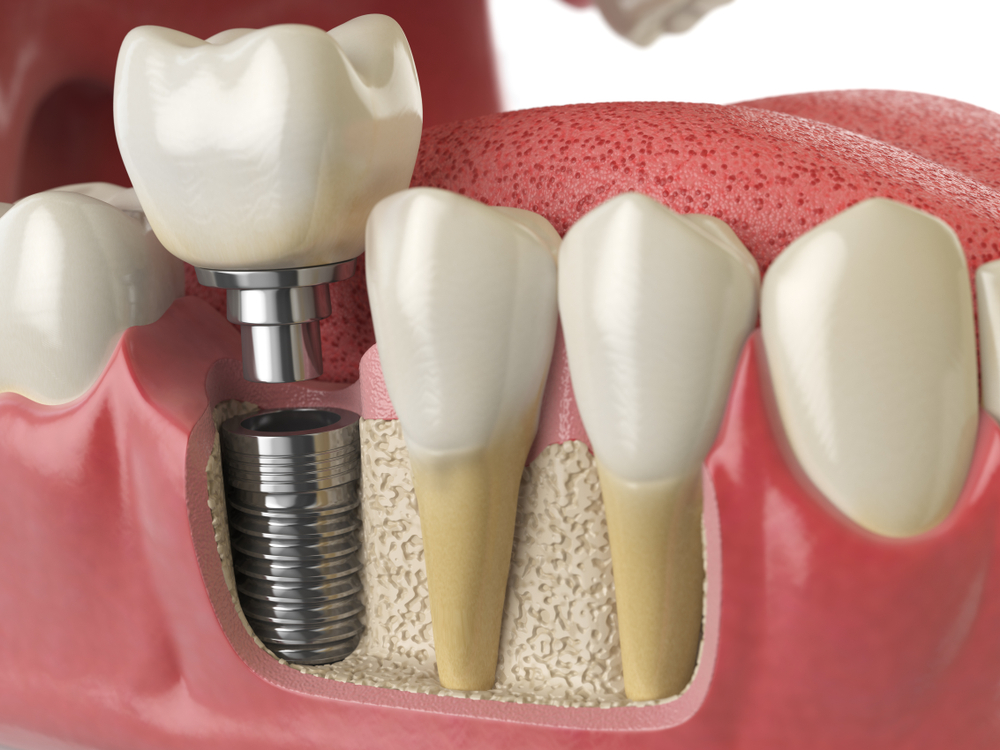Do Dental Implants Work Like Real Teeth